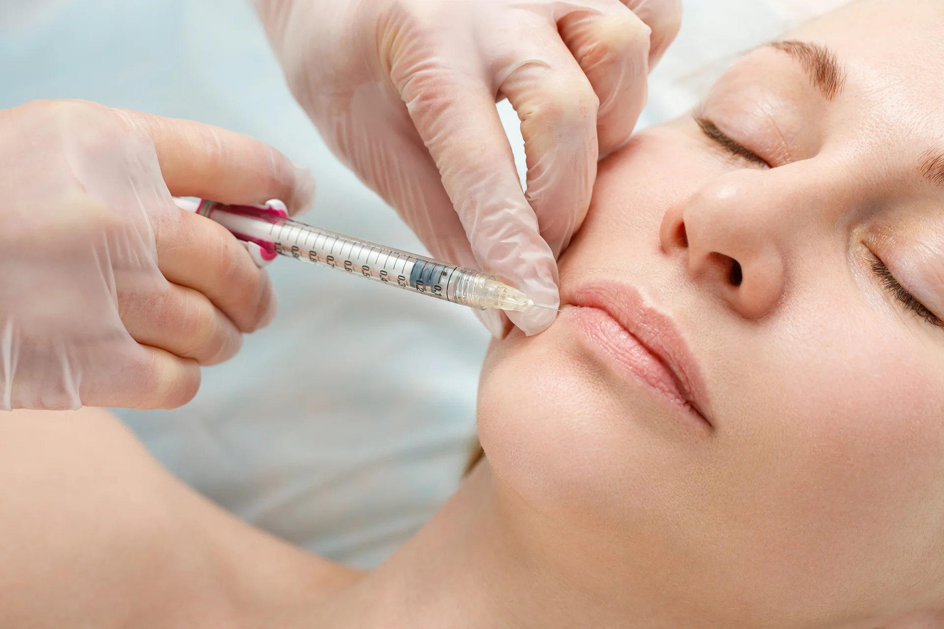 Get Naturally Full and Voluminous Lips with Versa Lip Filler