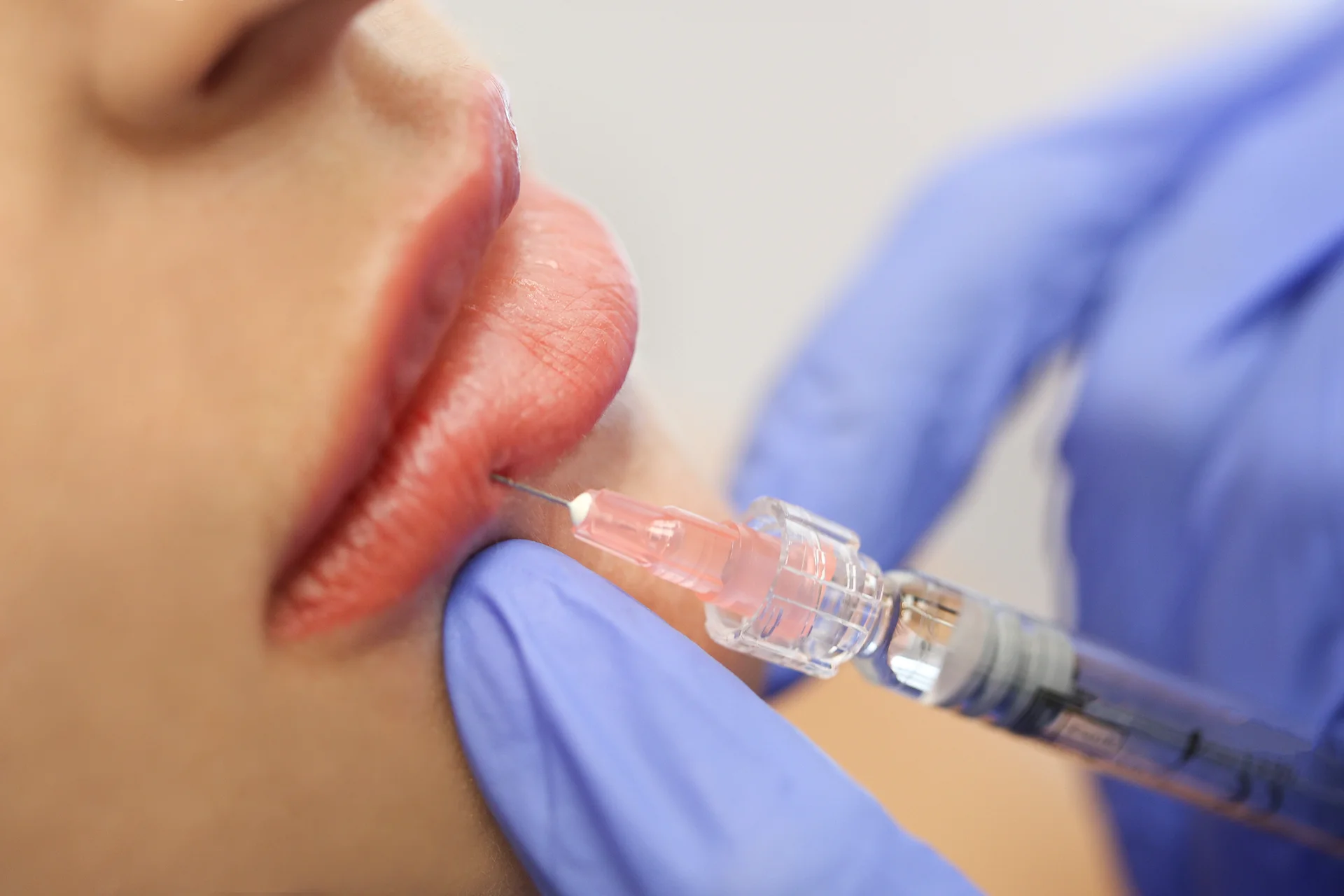 What Age Can You Get Lip Fillers?
