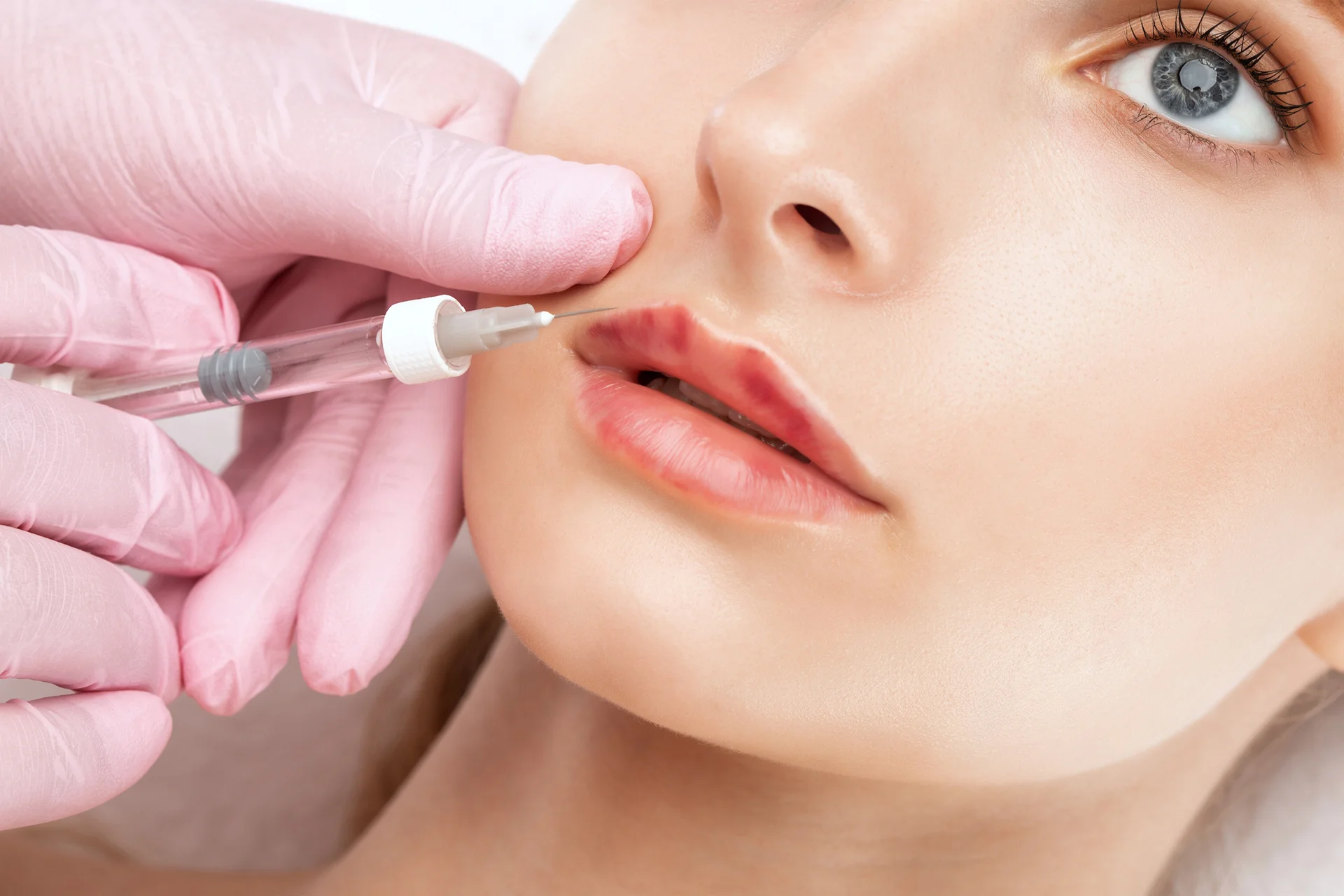 White Blanching After Lip Filler