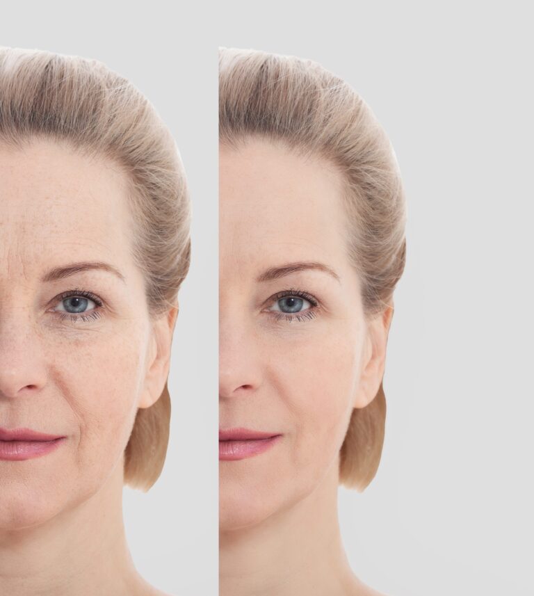 face lift dermal fillers chemical peel brow lift eyelid surgery|