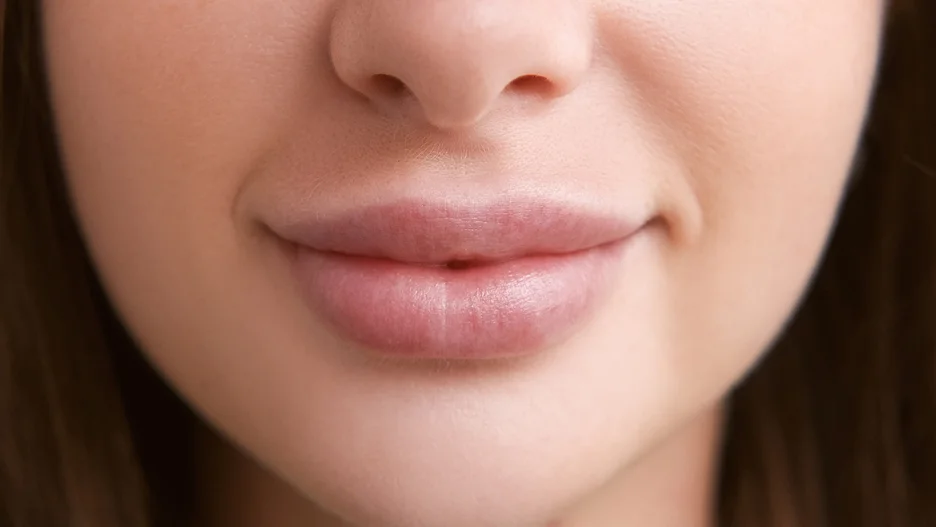 lip filler above lip line