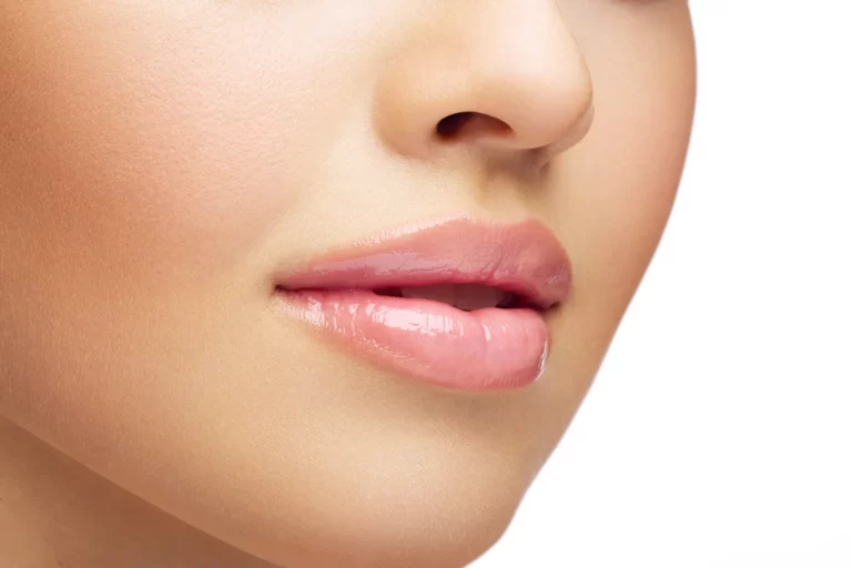 lip fillers for wrinkles