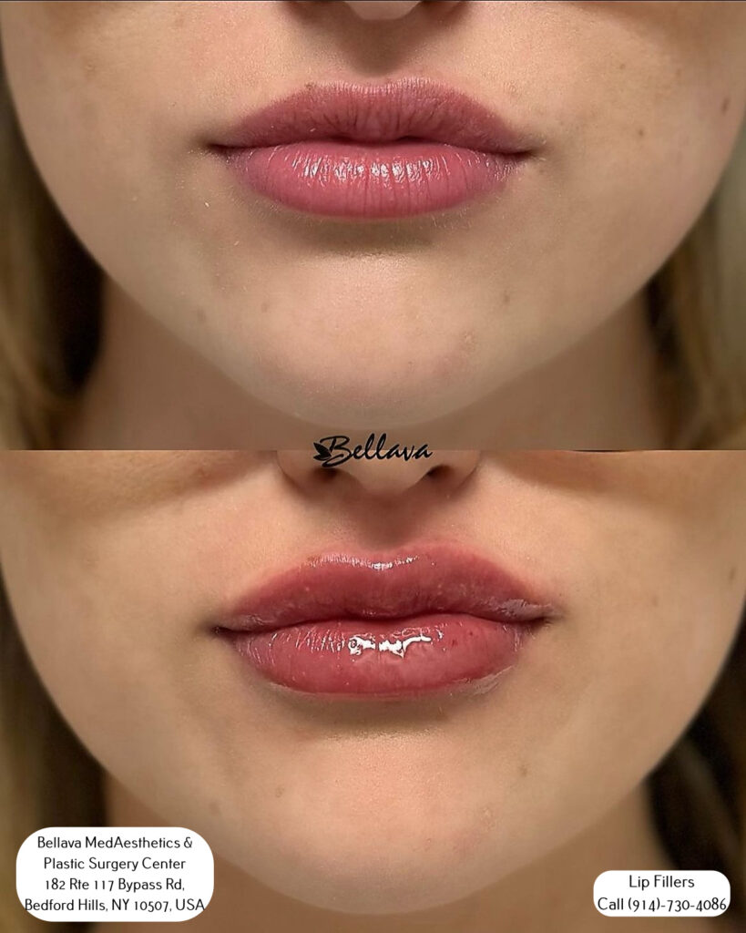 lip filler treatment at Bellava MedAesthetics