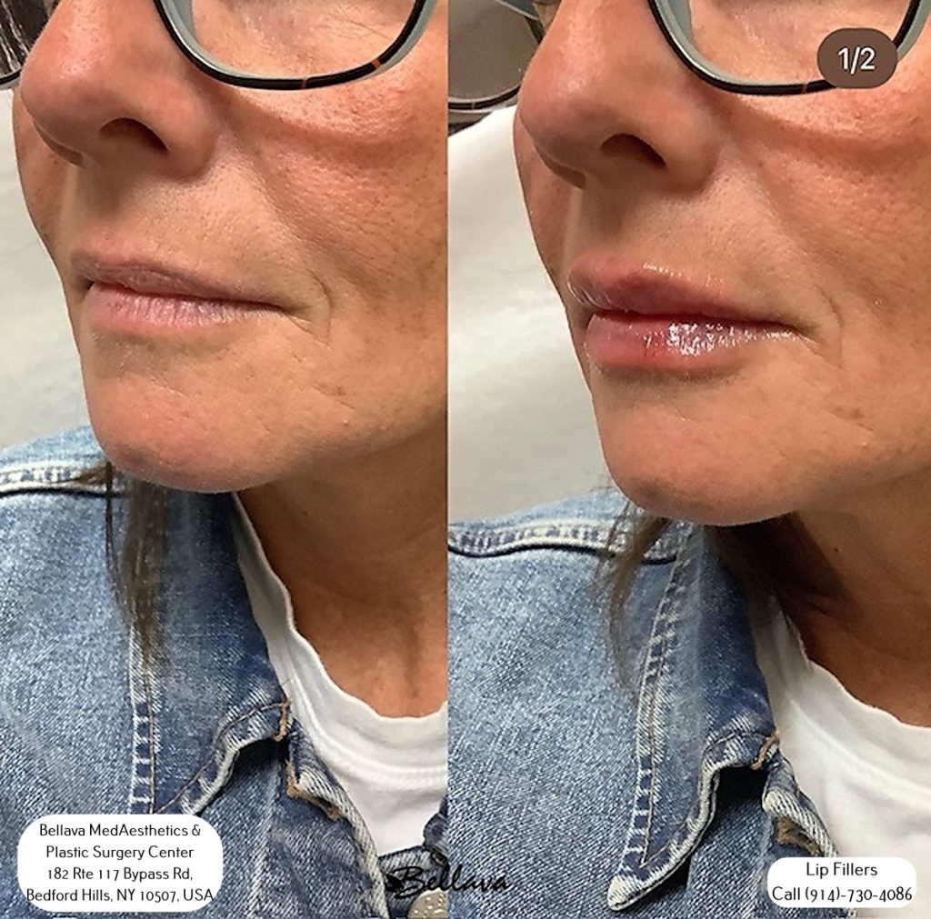 lip filler on small mouth