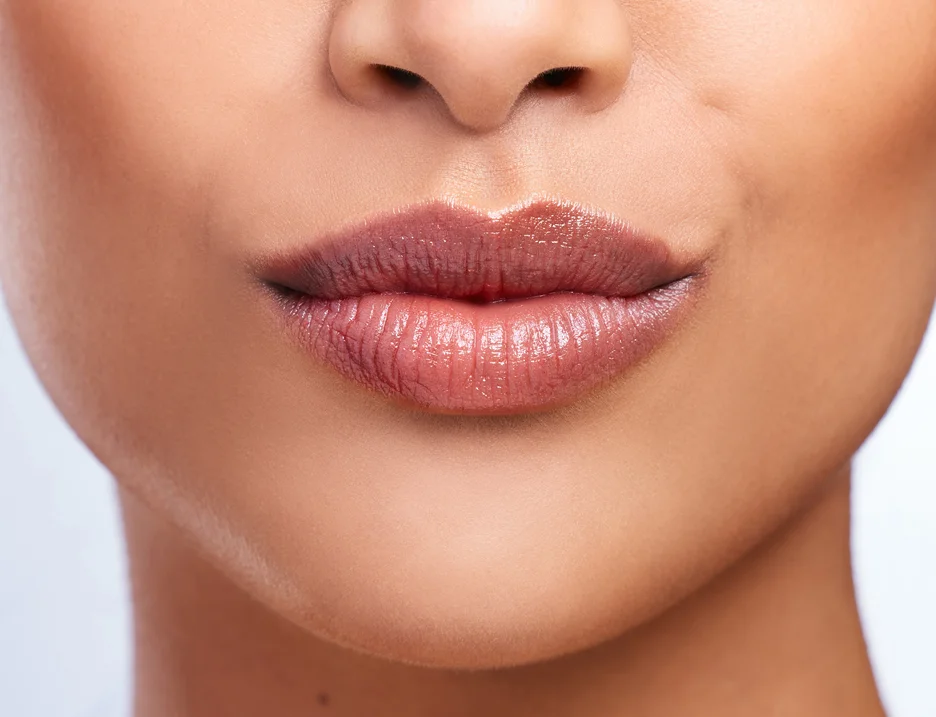 full, plump lips after top lip filler