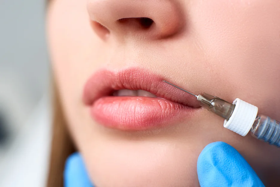 upper lip filler treatment