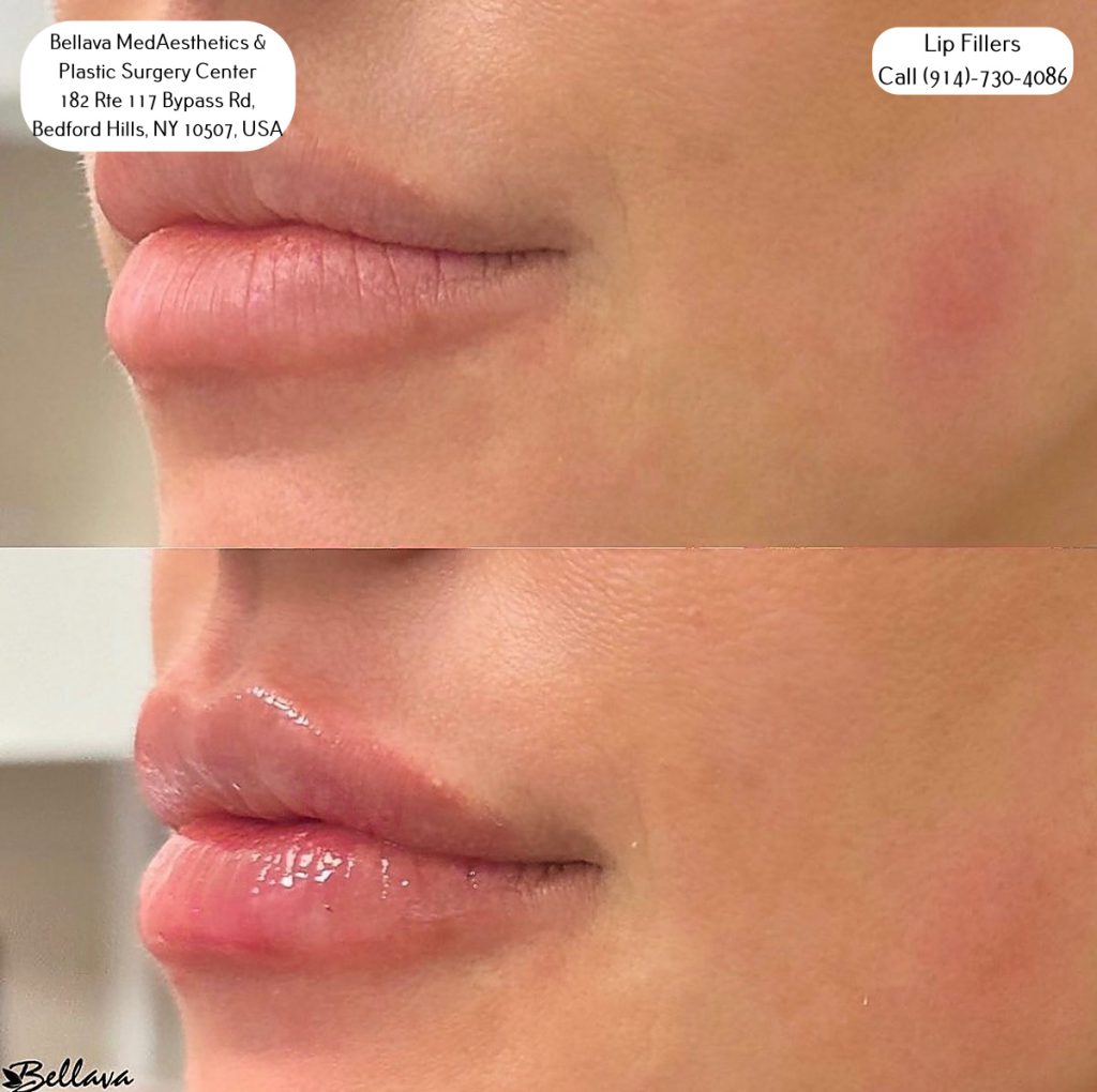 lip filler treamtents at Bellava MedAesthetics