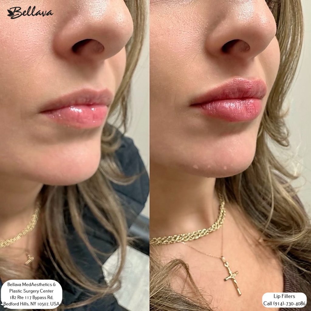 lip filler treatments at Bella MedAesthetics & Plastic Surgery