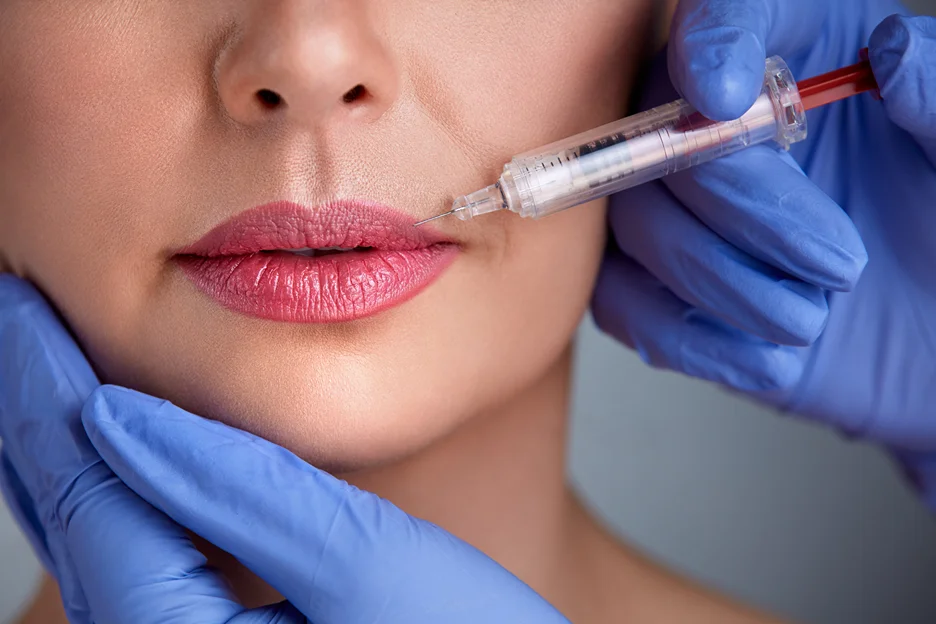 a woman received lip filler injections