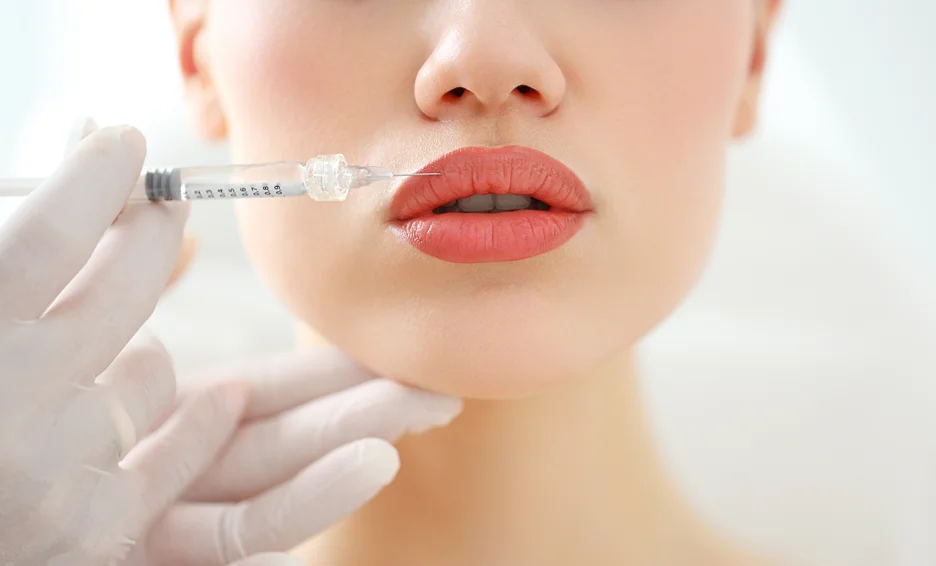 a woman received restylane kysse lip filler injection on her lips