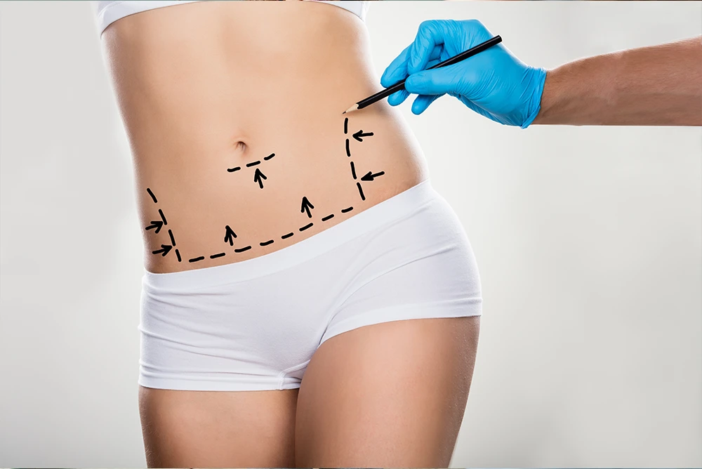 Plastic surgeon marking abdominal area before tummy tuck procedure
